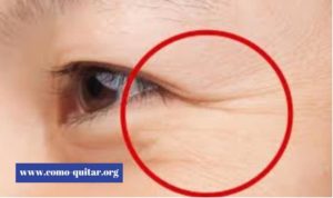 Como Quitar Arrugas de Ojos sin Cirugía